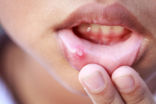 Mouth Ulcer